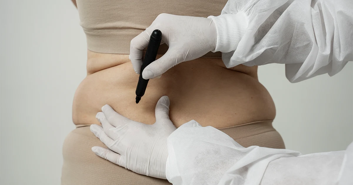 Liposucción de Espalda